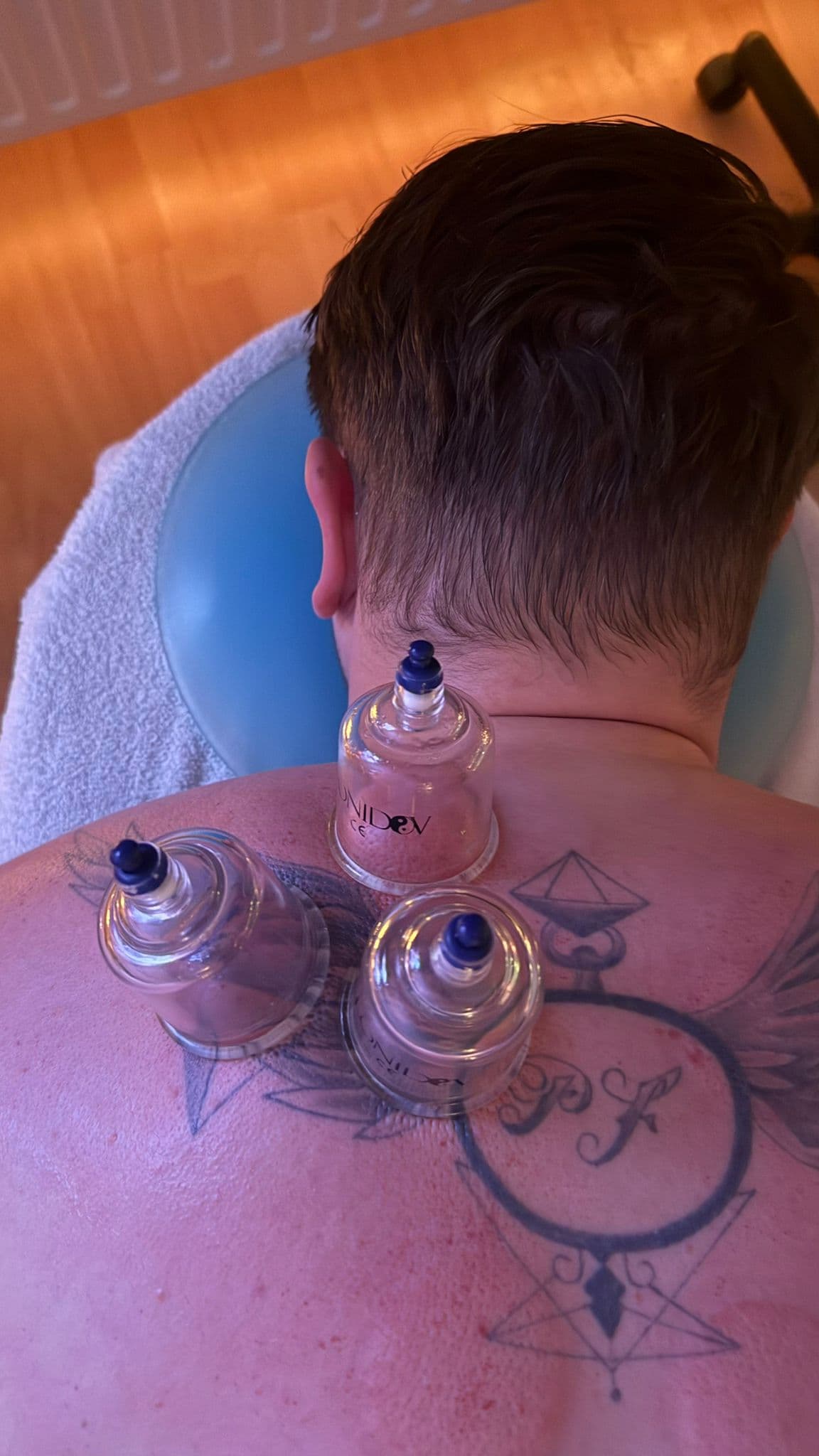 Cupping behandeling